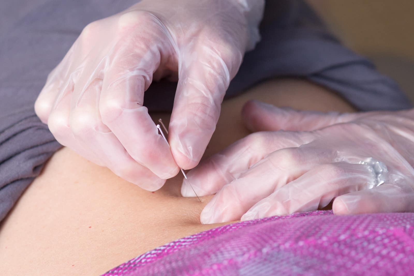 Fusion PT offers dry needling